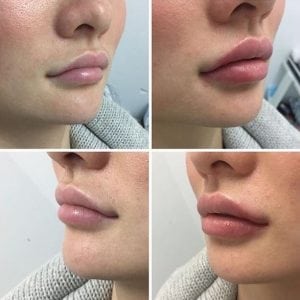 Iniezioni cosmetiche del labbro del gel liquido del riempitore di aumento del labbro di sicurezza di bellezza