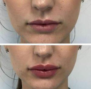 Iniezioni cosmetiche del labbro del gel liquido del riempitore di aumento del labbro di sicurezza di bellezza